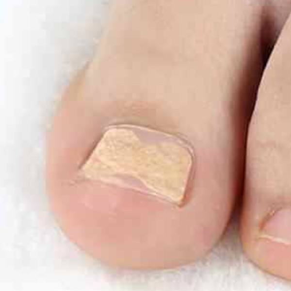 plasture ciuperca unghiilor de la picioare