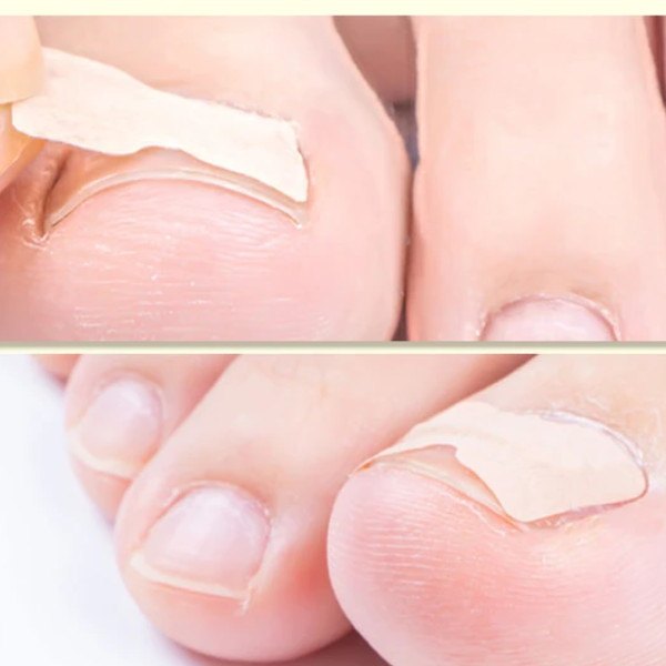 plasture ciuperca unghiilor de la picioare)