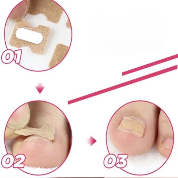 plasture ciuperca unghiilor de la picioare)