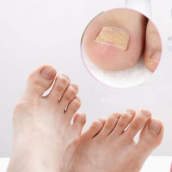 tratamentul podelei ciupercii unghiilor cum să recunoști ciuperca unghiilor de la picioare